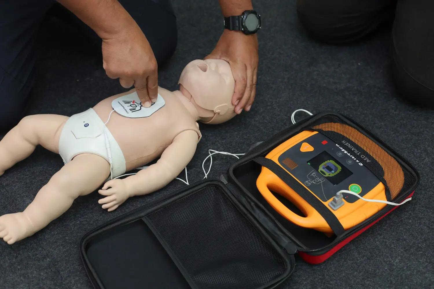 Aplicação do DEA em criança com eletrodos pediátricos atenção ao posicionamento anterior-posterior. A desfibrilação precoce aumenta drasticamente as chances de reversão da parada cardíaca em pacientes pediátricos.